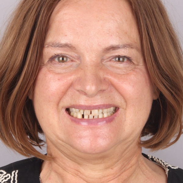 Ewa Przed Zabiegiem