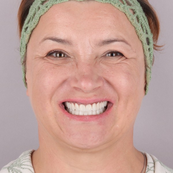 Agnieszka Po Zabiegu