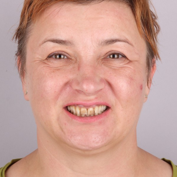 Agnieszka Przed Zabiegiem