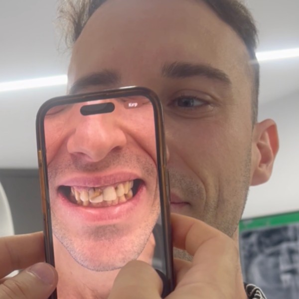 Paweł Przed Zabiegiem
