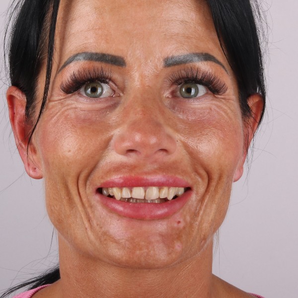 Katarzyna Przed Zabiegiem