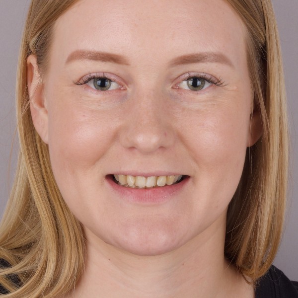 Agnieszka Przed Zabiegiem