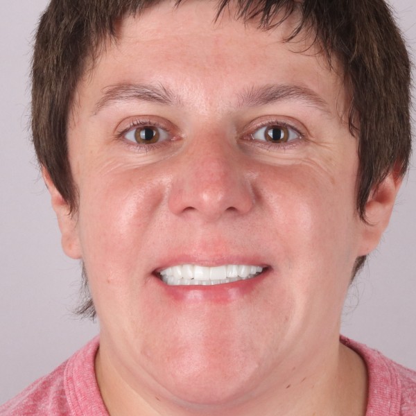 Gabriela Po Zabiegu