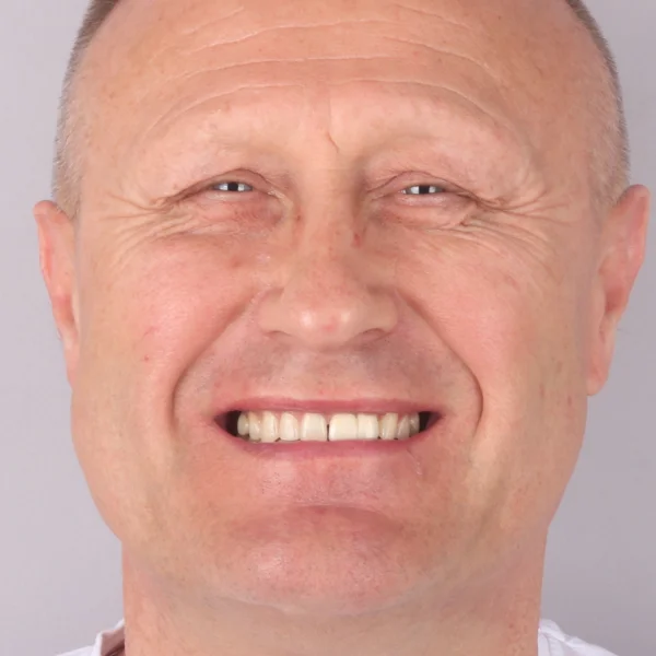 Dariusz, uśmiech przed leczeniem w Turcji