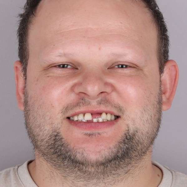 Grzegorz Przed Zabiegiem