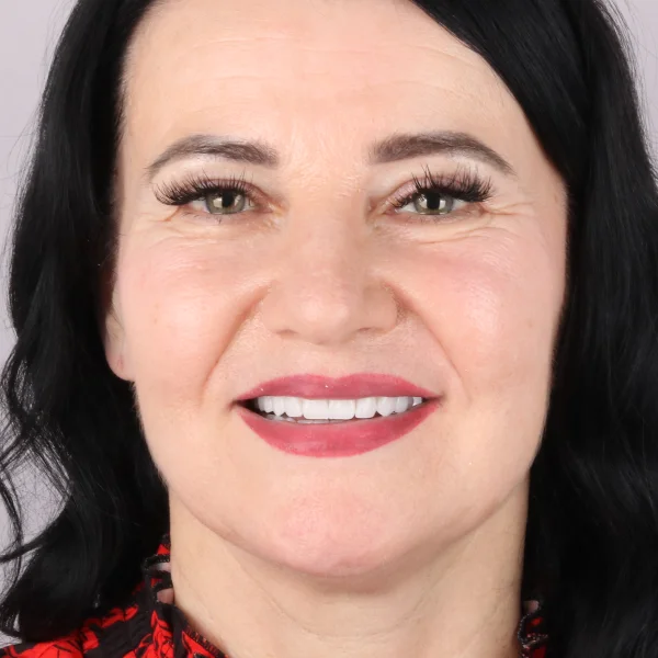 Jolanta, uśmiech po leczeniu w Turcji