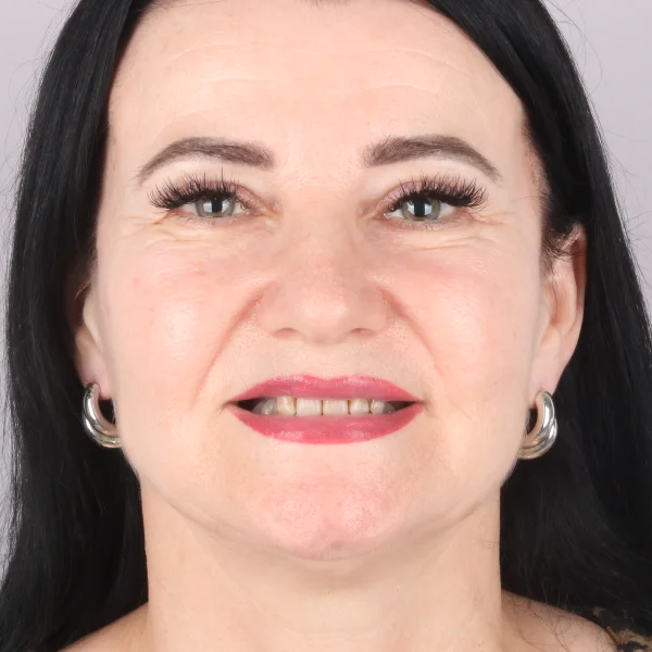 Jolanta, uśmiech przed leczeniem w Turcji
