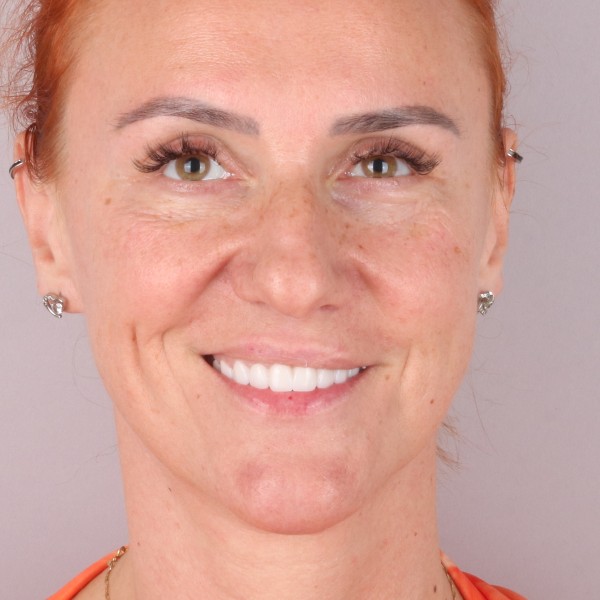 Iwona Po Zabiegu