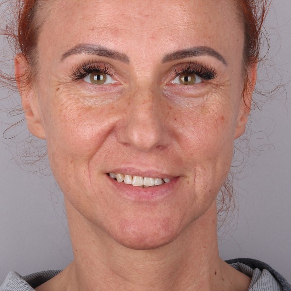 Iwona Przed Zabiegiem
