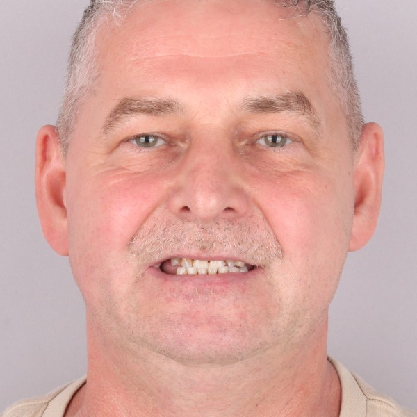 Andrzej Przed Zabiegiem