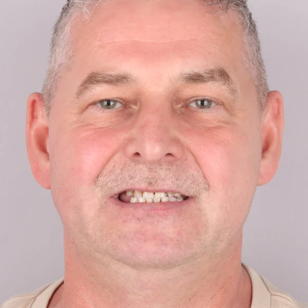 Andrzej, uśmiech przed leczeniem w Turcji