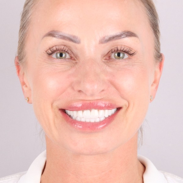 Sylwia Po Zabiegu