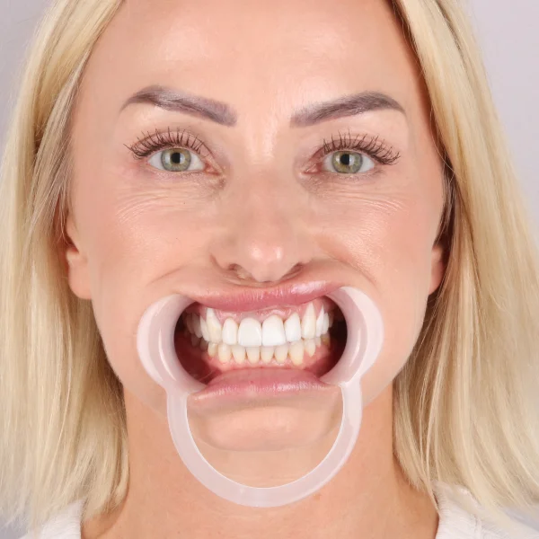 Sylwia, uśmiech przed leczeniem w Turcji