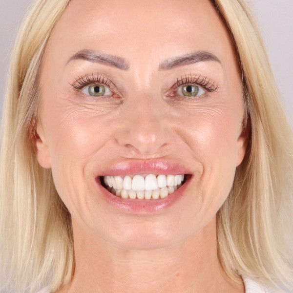 Sylwia Przed Zabiegiem