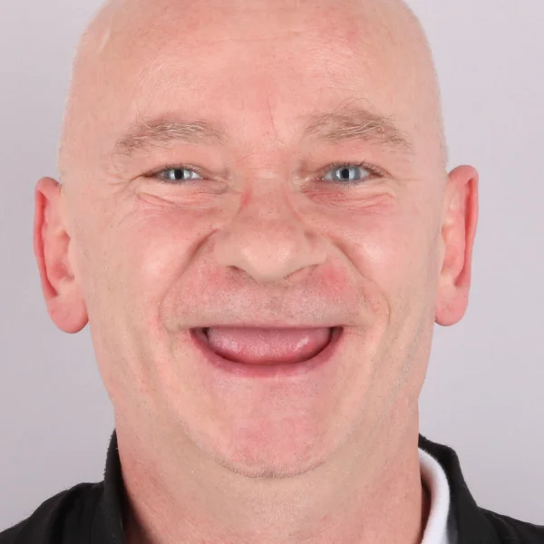 Krzysztof, uśmiech przed leczeniem w Turcji